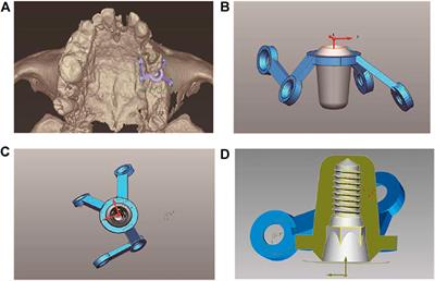 Digital Workflow for the Design, Manufacture, and Application of Custom-Made Short Implants With Wing Retention Device